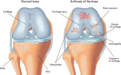 Exploring the Benefits of MLS Laser Therapy for Knee Osteoarthritis