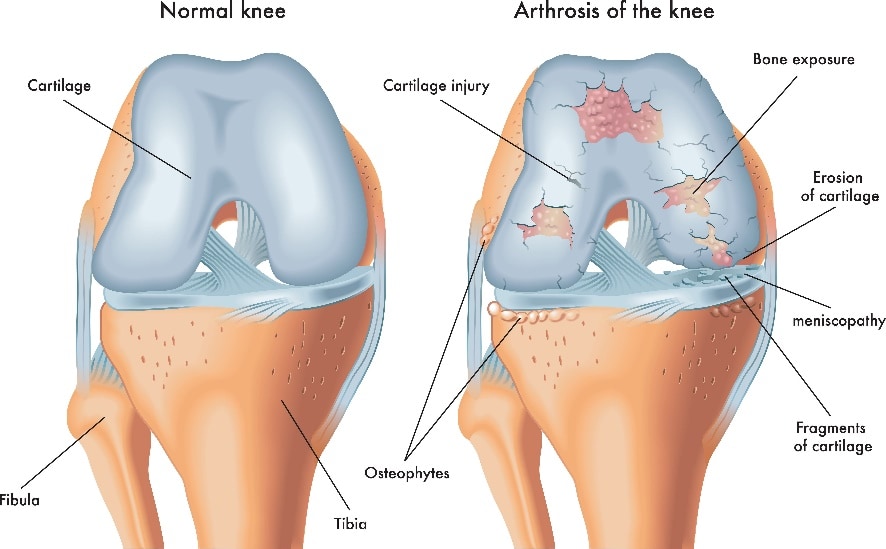 Exploring the Benefits of MLS Laser Therapy for Knee Osteoarthritis