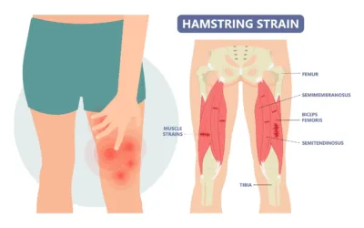 Harnessing the Power of MLS Laser Therapy for Muscle Strains and Sprains