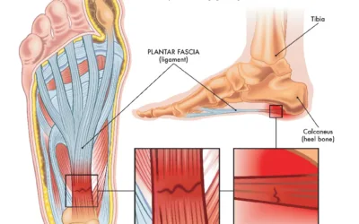 Revolutionizing Plantar Fasciitis Treatment: The Power of MLS Laser Therapy