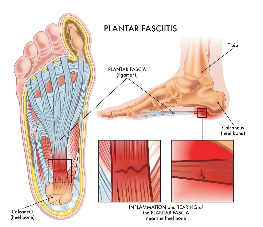 Revolutionizing Plantar Fasciitis Treatment: The Power of MLS Laser Therapy